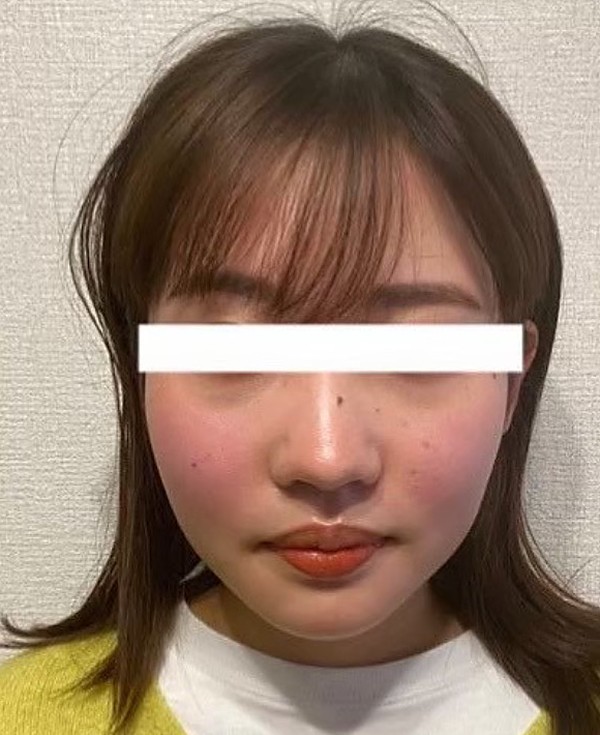 施術3回目