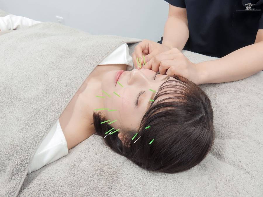 鍼灸師による施術